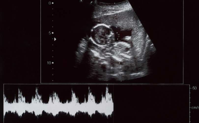 EUA: Lei estadual pode impedir aborto após 6 semanas de gestação